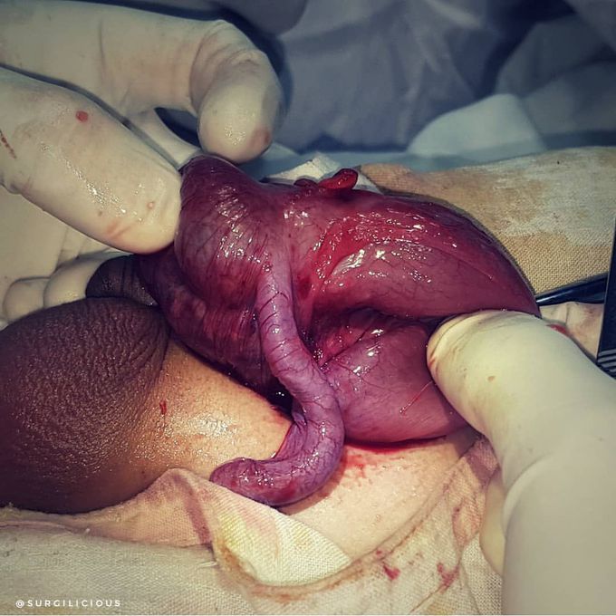 LEFT-SIDED AMYAND'S HERNIA in 2 y.o boy 