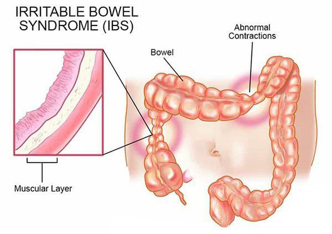 Triggers of IBS-Constipation