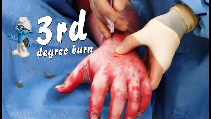 Escharotomy Procedures I Severe 3rd degree burn