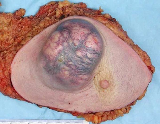 Here is a gross image of a very late stage of an invasive ductal cancer of the breast