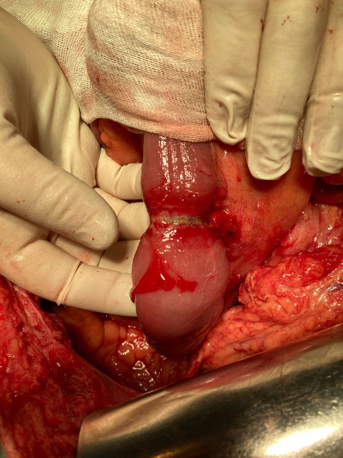 Post-op stranglehold of ileum 😬