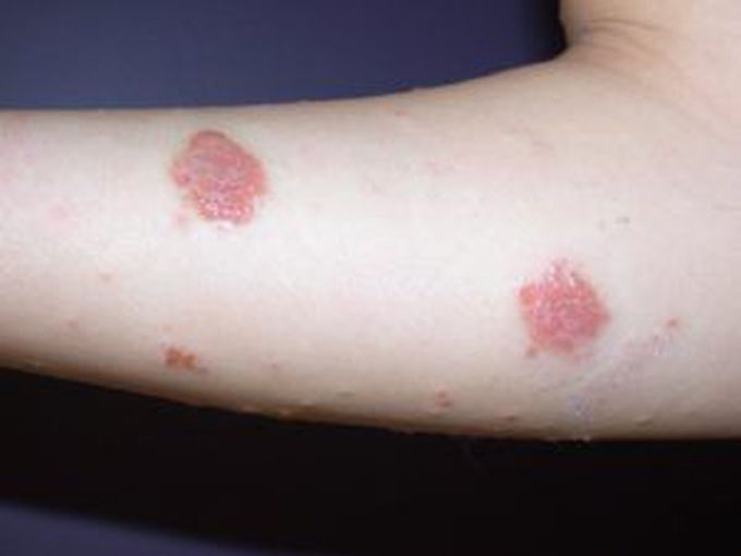 Cause of Discoid eczema