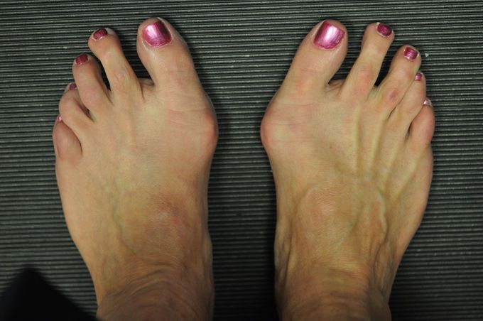 symptoms of a bunion