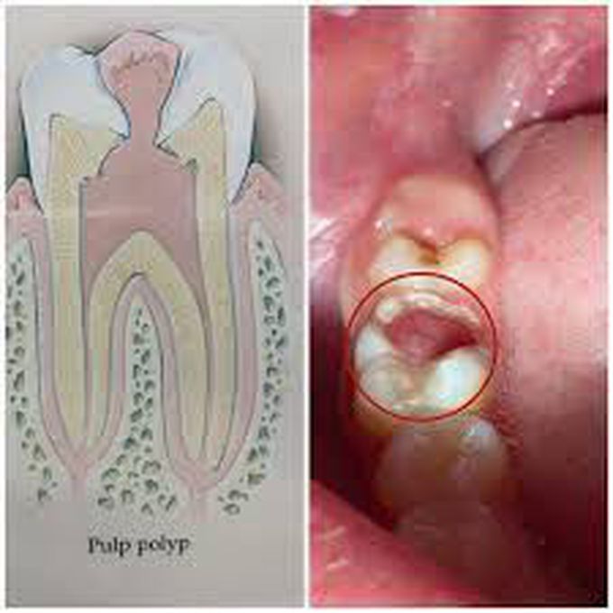 Pulp polyp