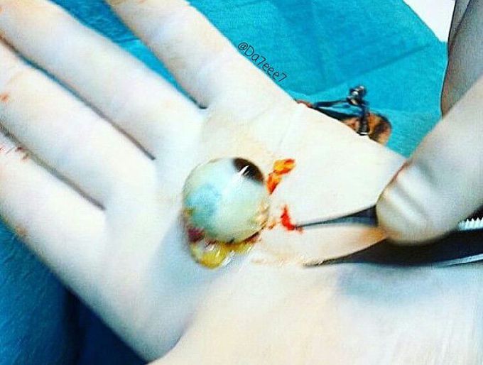 Enucleation of the eye