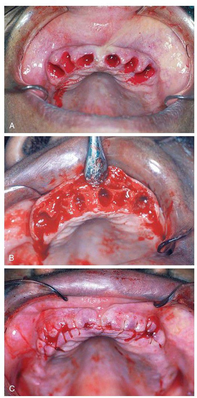 Simple alveoloplasty