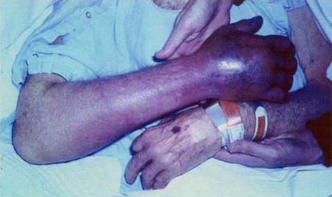 Purple glove syndrome. Causative drug?