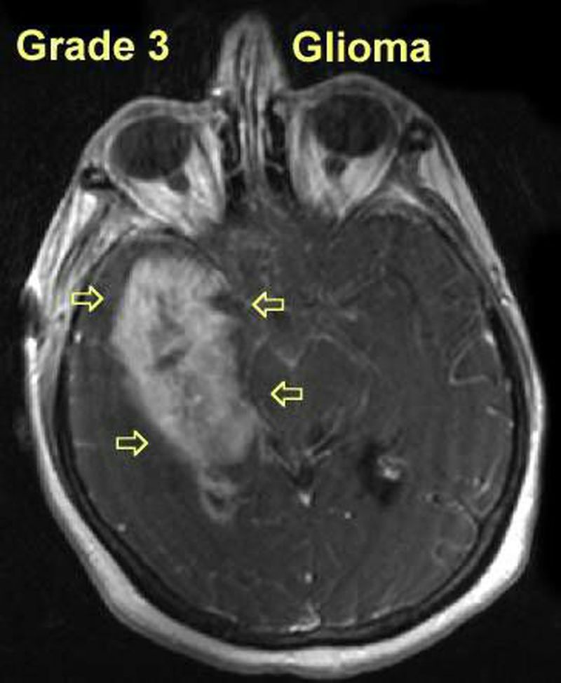 Астроцитома грейд. Глиома ствола мозга мрт.