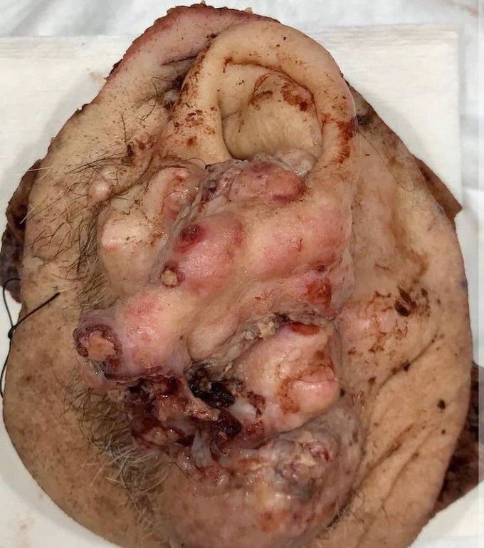 Parotid mass invading the ear