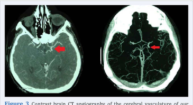 Berry Aneurysm AKA Saccular Cerebral Aneurysm