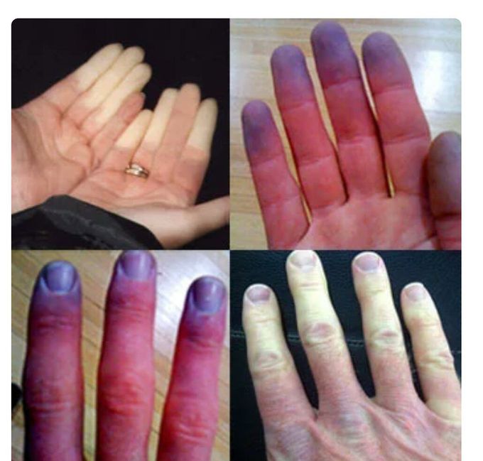 Raynauds phenomenon