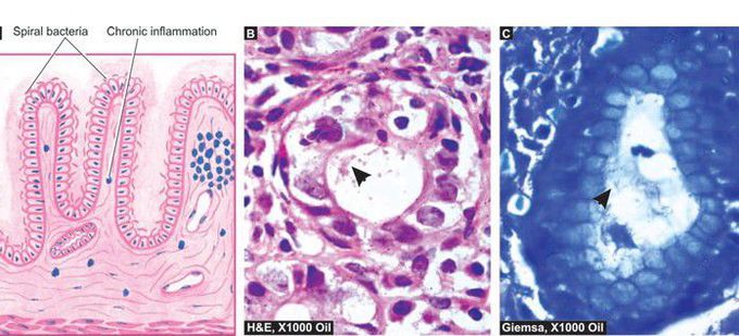 Histologic appearance of H. pylori chronic gastritis.