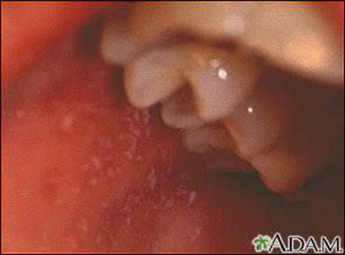 A child with fever, sore throat and sweating is presented in the paediatric OPD. Upon physical examination, this is observed inside the oral mucosa. What is the diagnosis of the child?