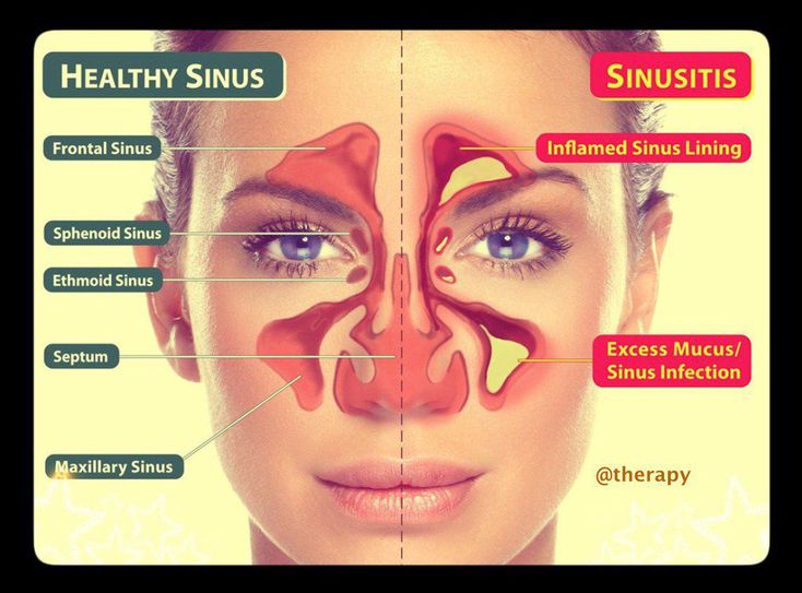 Sinusitis Medizzy
