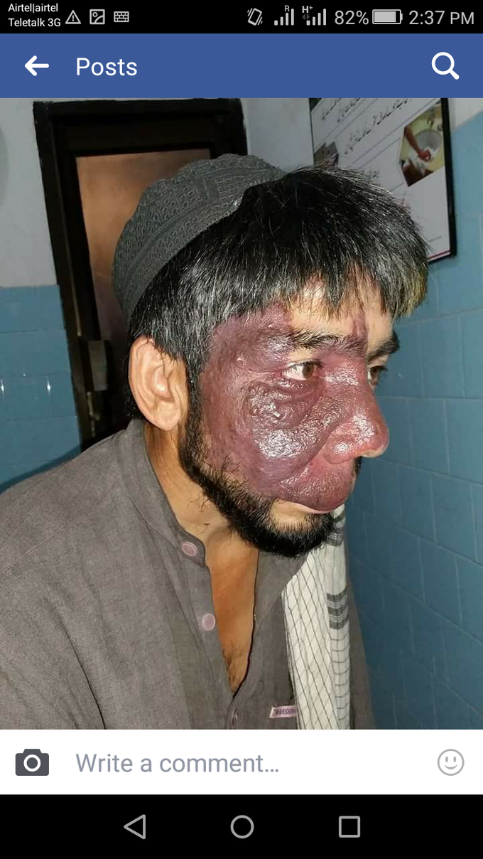 Port wine stain