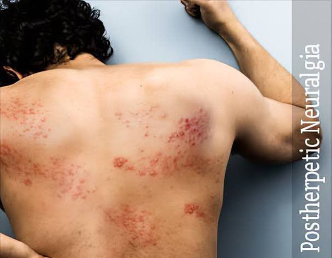 Post herpetic neuralgia - MEDizzy