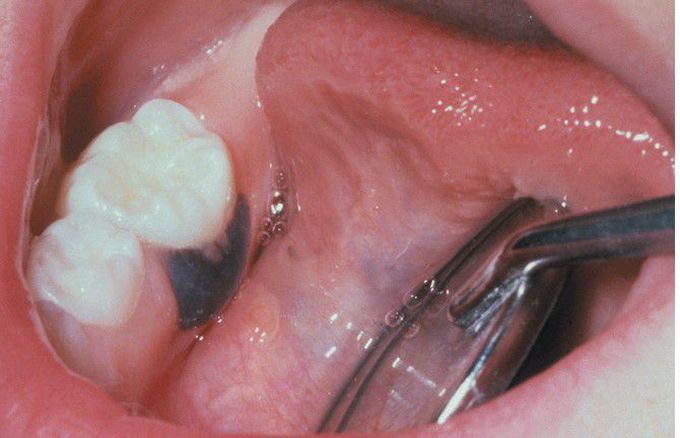 Congenital Melanocytic Nevus