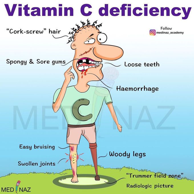 Vitamin C deficiency