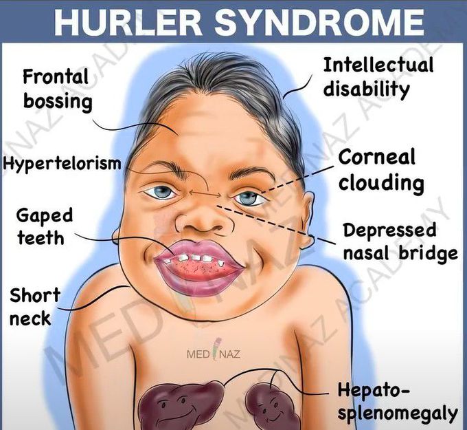 Hurler syndrome- Mnemonic