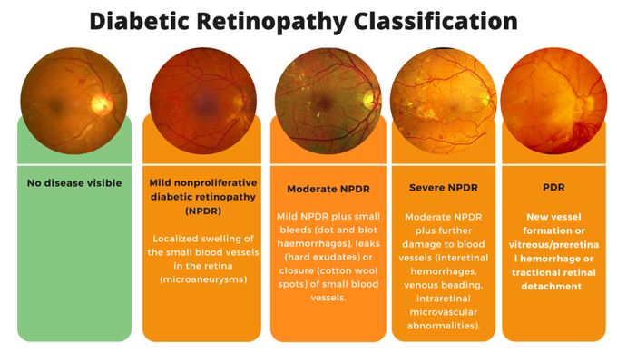 Diabetic Retinopathy classification