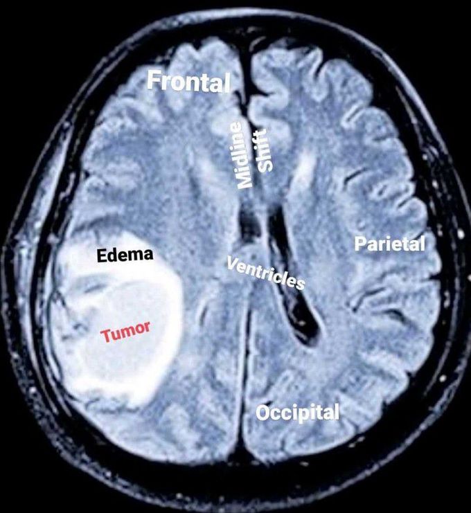 Neurosurgery