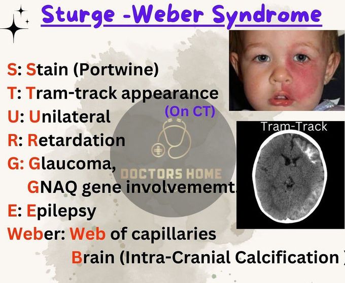 Sturge Weber Syndrome