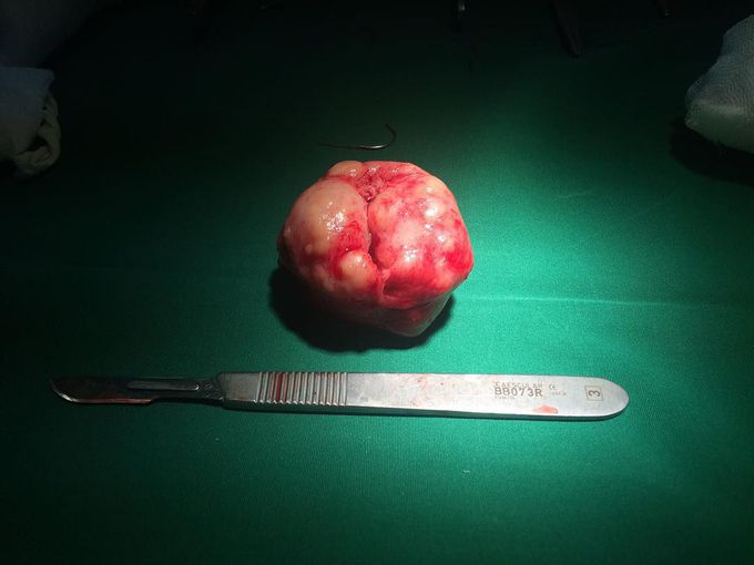 Benign Prostate Hyperplasia