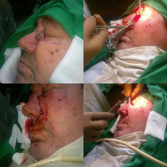 Basal cell carcinoma excision