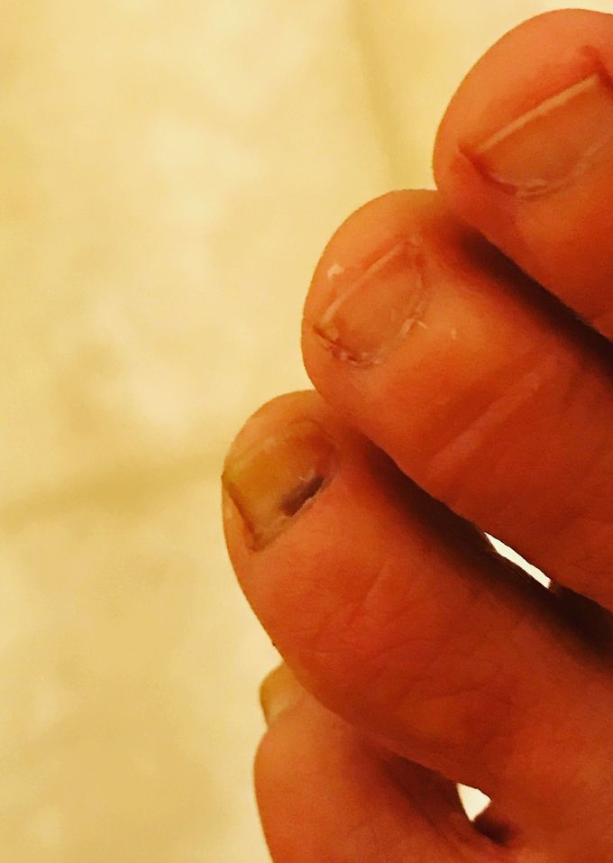 Toenail lesions