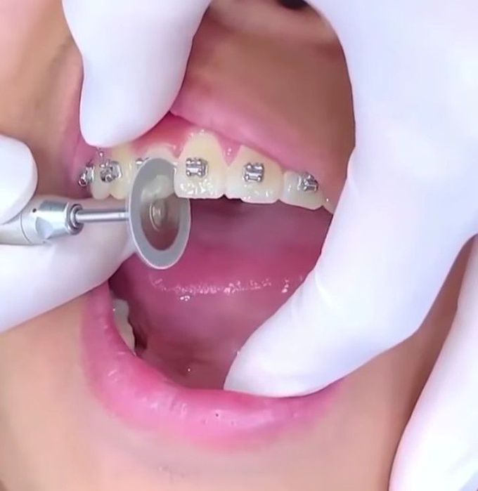 Interproximal reduction (IPR)