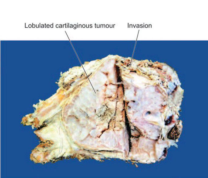 Chondrosarcoma