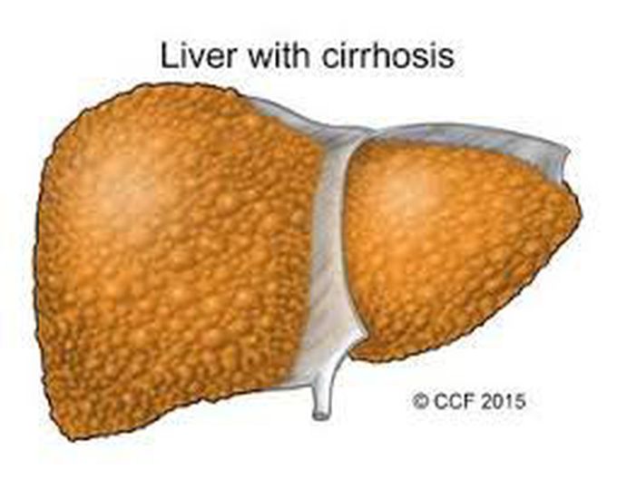 Cirrhosis of liver