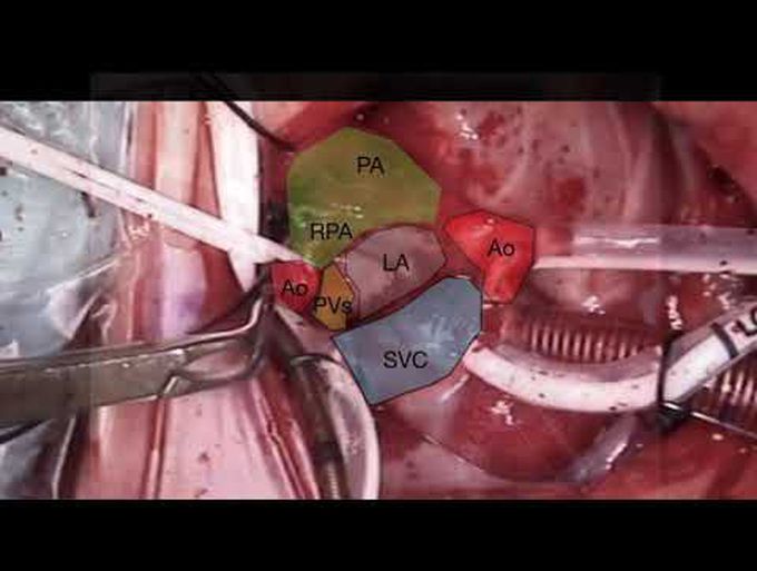 Superior Approach for Correction of Supracardiac Type of Total Anomalous Pulmonary Venous Drainage