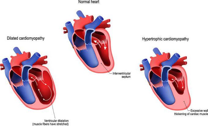 Cardiomyopathy