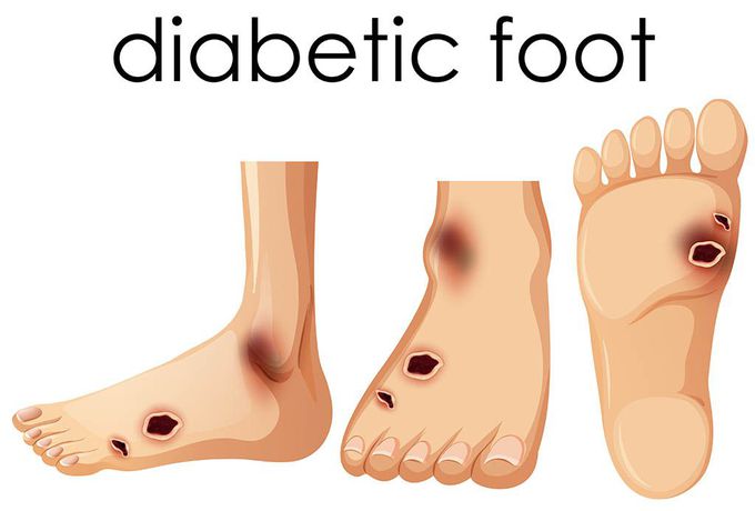 Symptoms of Diabetic foot