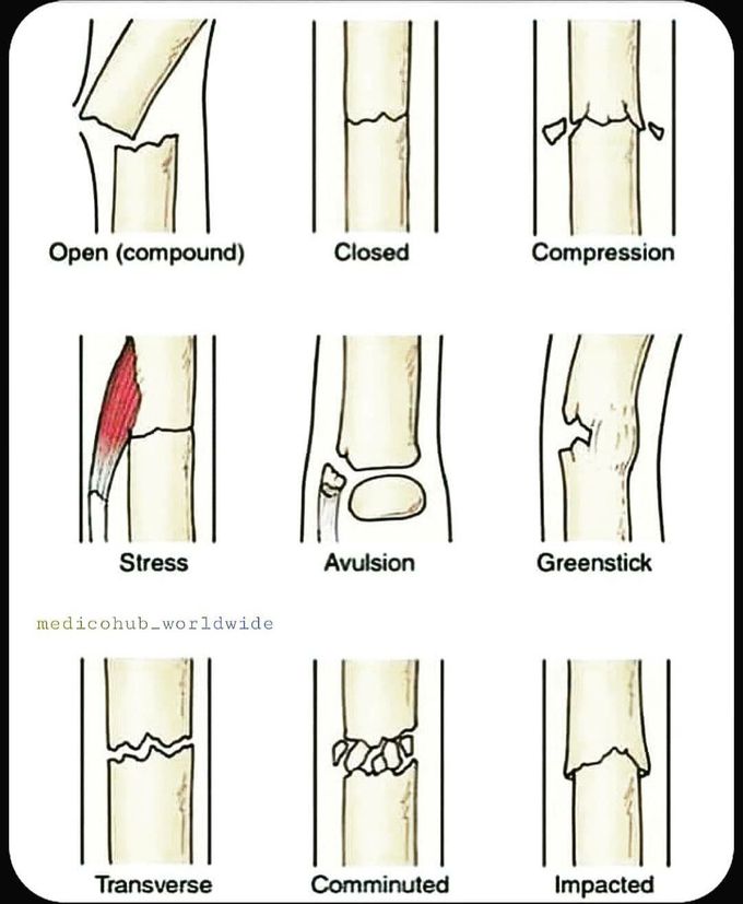 Types of fracture...