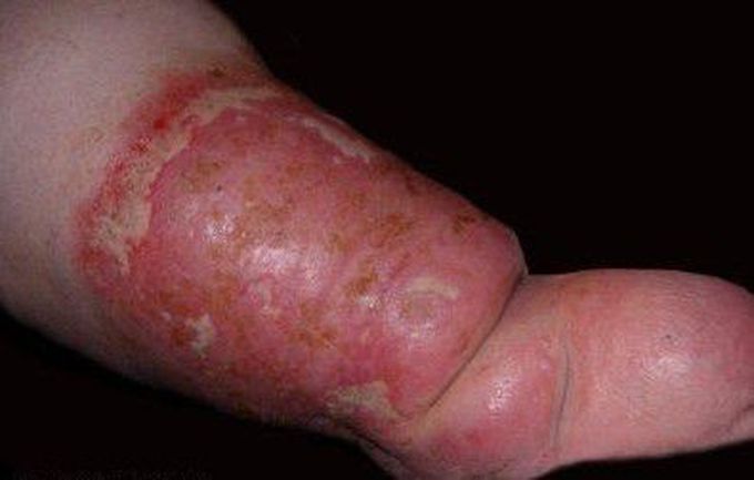 Lymphedema – Overview and Etiology