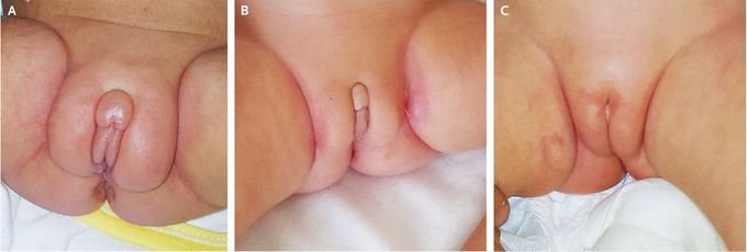 Preterm Ovarian Hyperstimulation