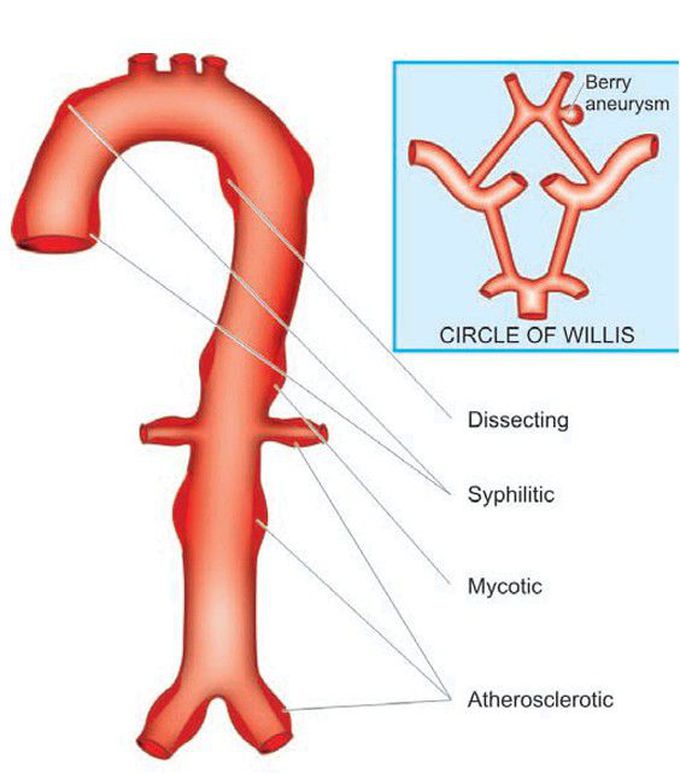 Aneurysms