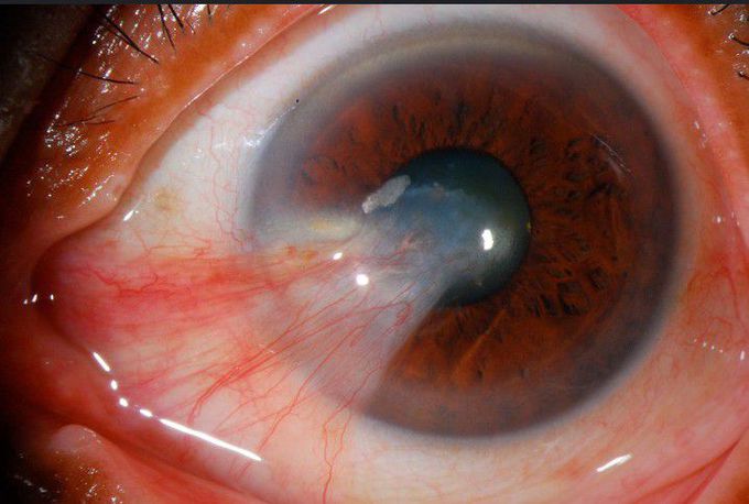 Pterygium