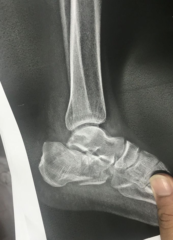 Where do you think the fraction is in this X-ray??