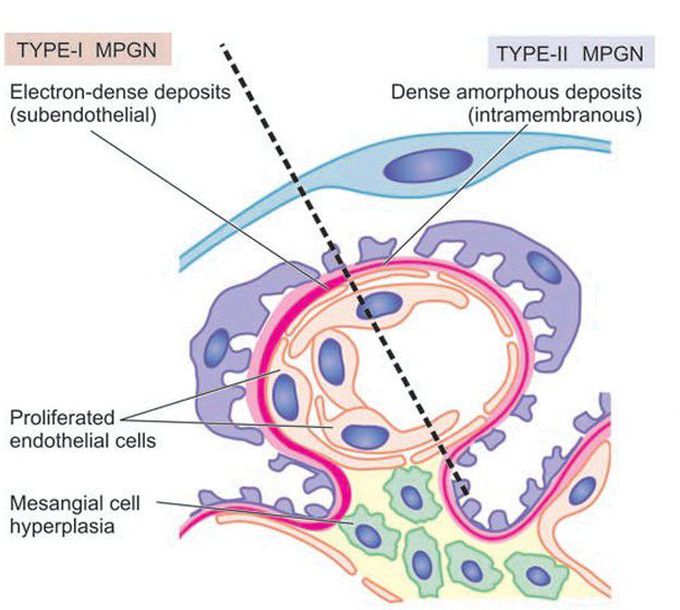 Membranoproliferative glomerulonephritis