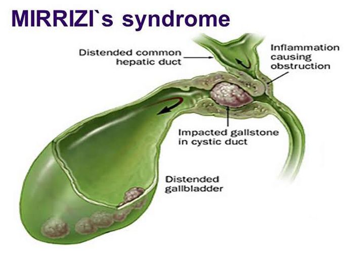 Mirrizi's Syndrome