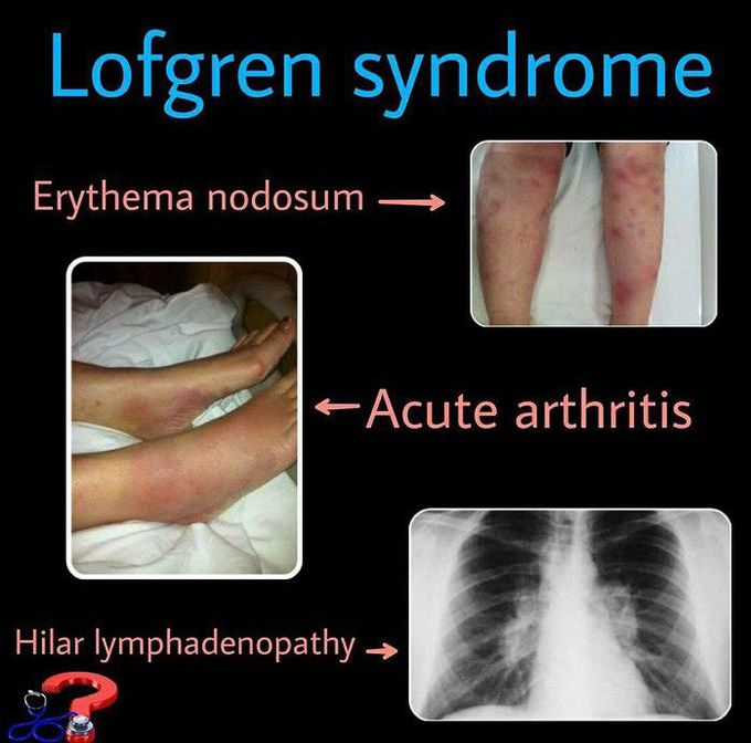 Lofgren Syndrome
