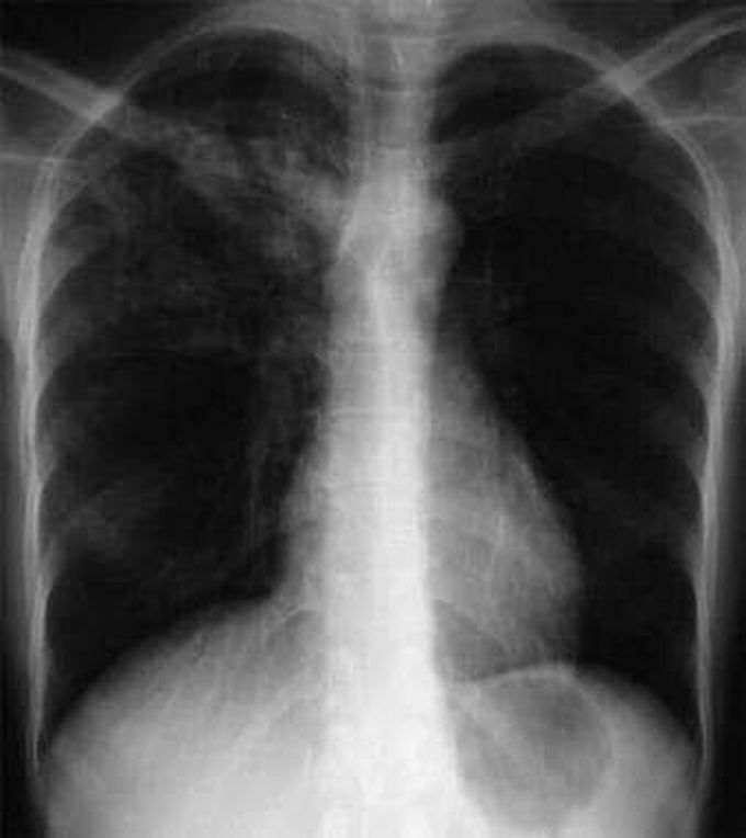 Symptoms of TB