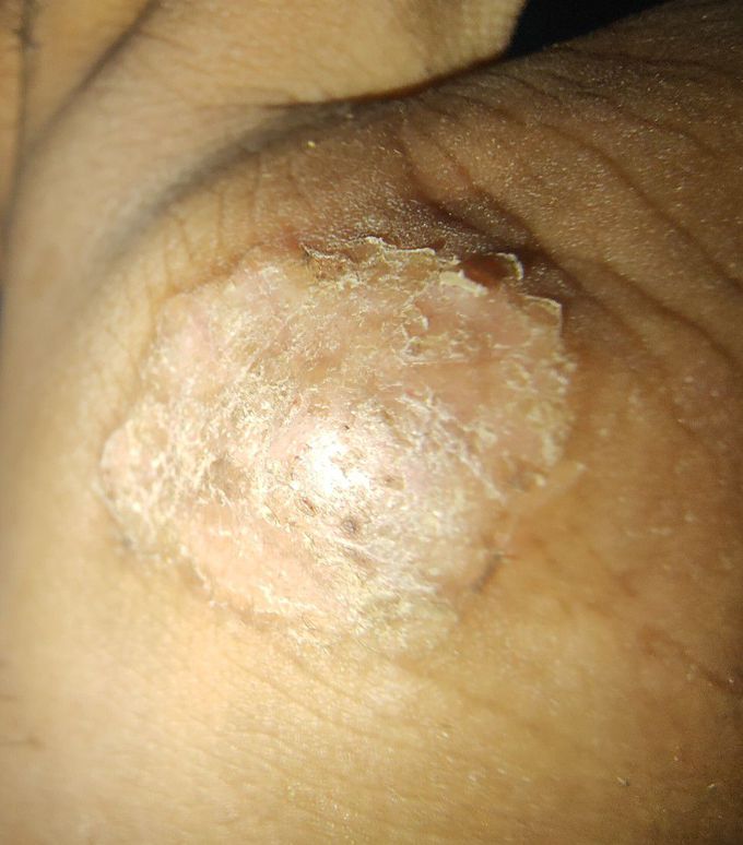 Scaly lesions, h/o pruritus, duration:since 1 month