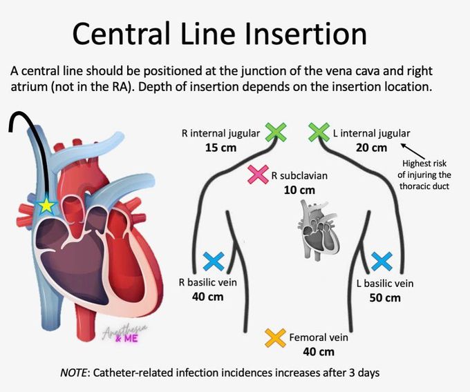 Central Line Insertion