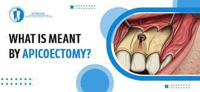 What is an apicoectomy?