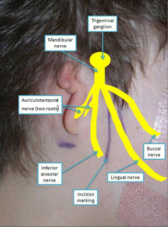 Frey's syndrome