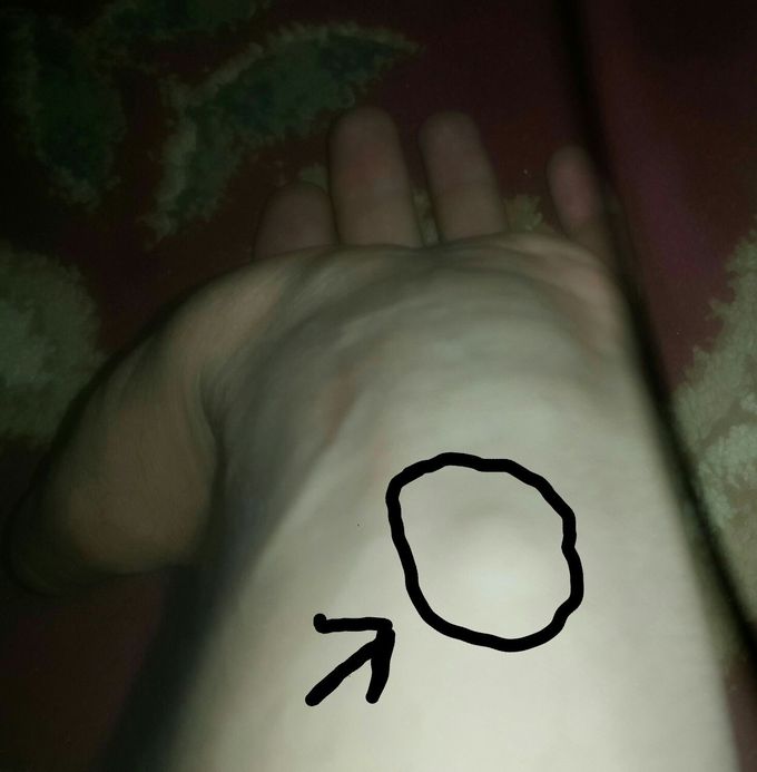Left hand Muscels Problum